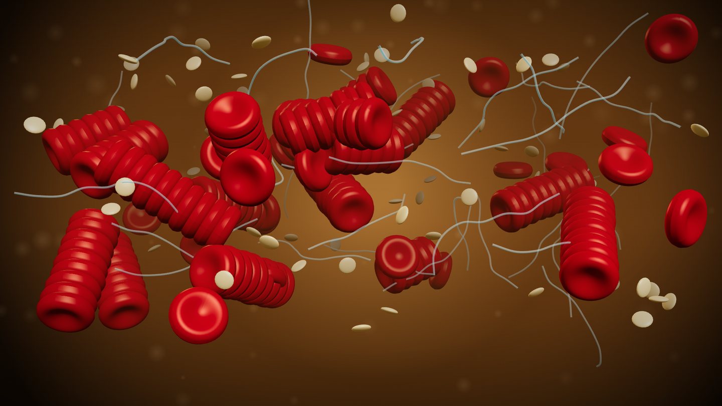 Illustration: rouleaux (stacked red cells) with smaller platelets suspended in plasma